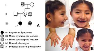 Angelman Syndrome